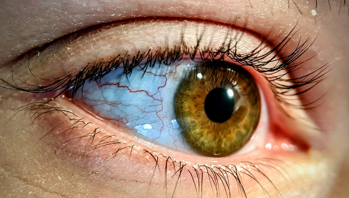 a close up of a person's brown eye related to Coverlet Eye Occlusor