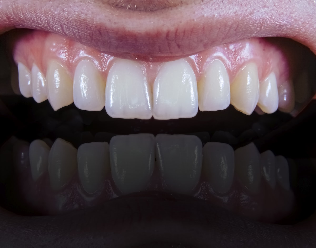 a close up of a person's mouth with a missing tooth related to The Ultimate Guide to Gli Front Valance: Enhancing Your Car's Aerodynamics