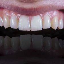 a close up of a person's mouth with a missing tooth related to The Ultimate Guide to Gli Front Valance: Enhancing Your Car's Aerodynamics