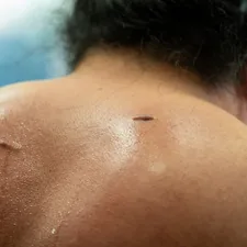 Sweaty neck of a sumo wrestler during practice related to The Itchy Truth About Bed Bug Bites: What You Need to Know